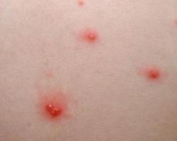 Мелкие красные точки на теле: фото, причины, лечение При загаре появляются белые пятна